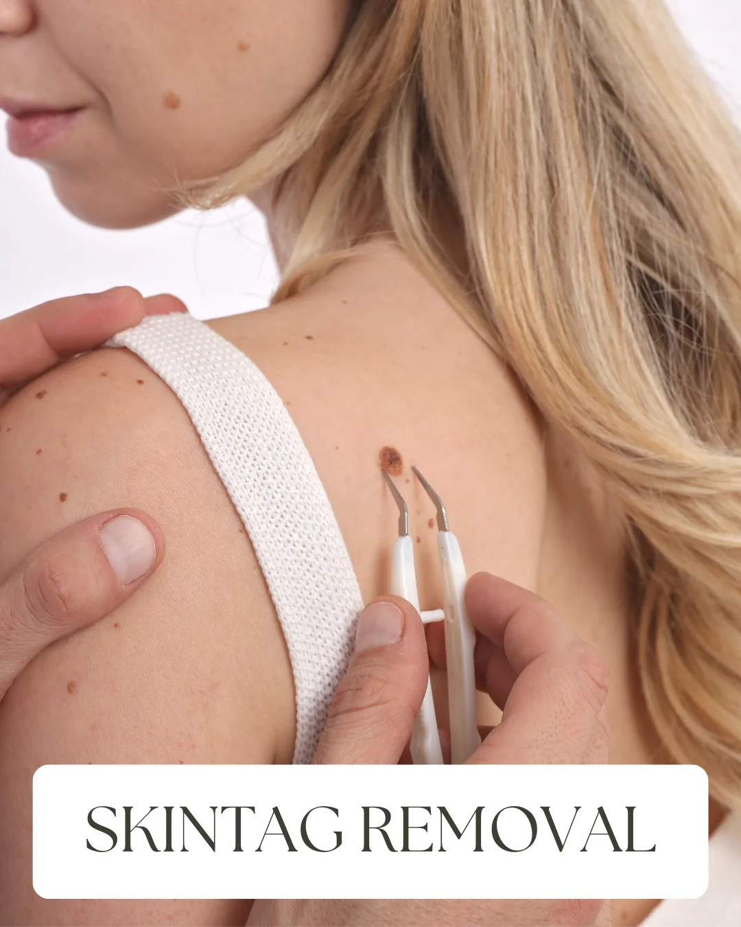 11. SkinTag Removal