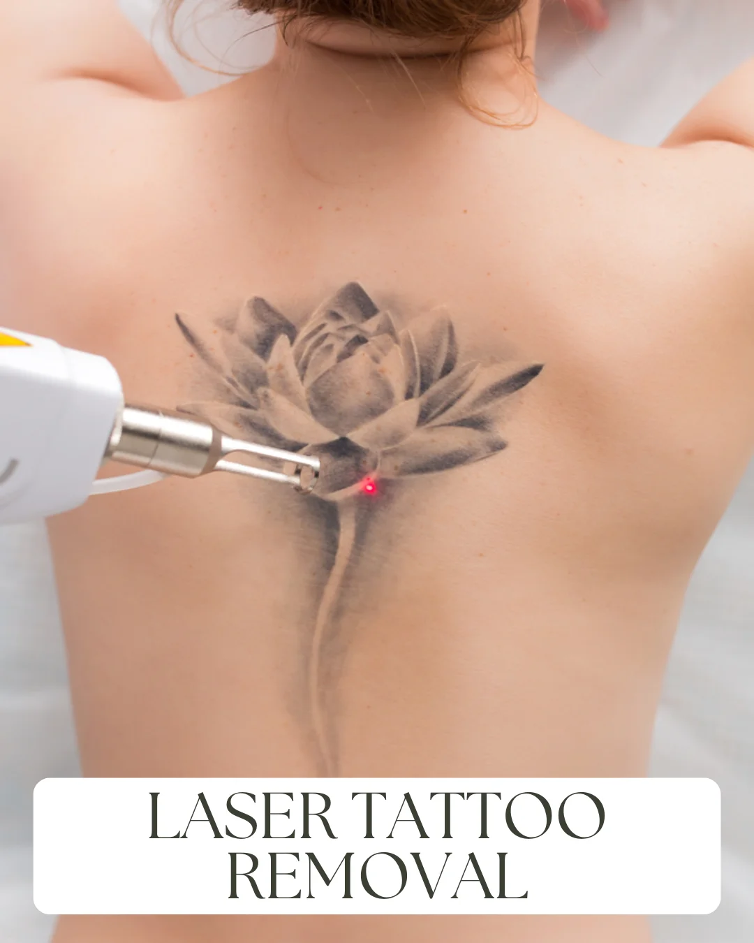 16. Laser Tattoo Removal